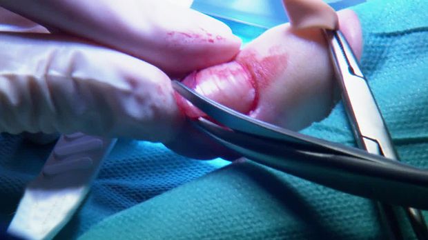 Nagelbettentzündung operation