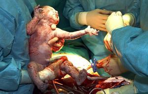 Baby bei der Geburt durch Kaiserschnitt